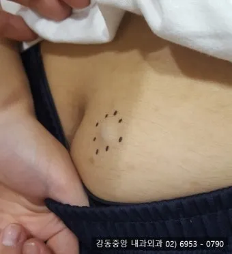 엉덩이 종기가 생기는 이유 왜 생기고 어떻게 관리할까요 완벽 가이드_13