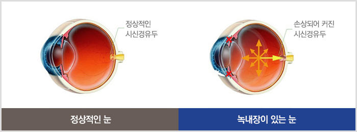 정상적인 눈과 녹내장이 있는 눈의 비교