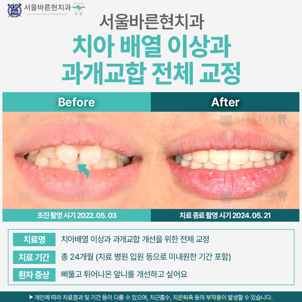 부산치아교정