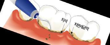 잇몸 내려앉음 치료