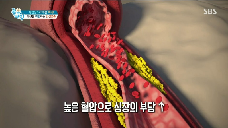 만성 염증 과 질환