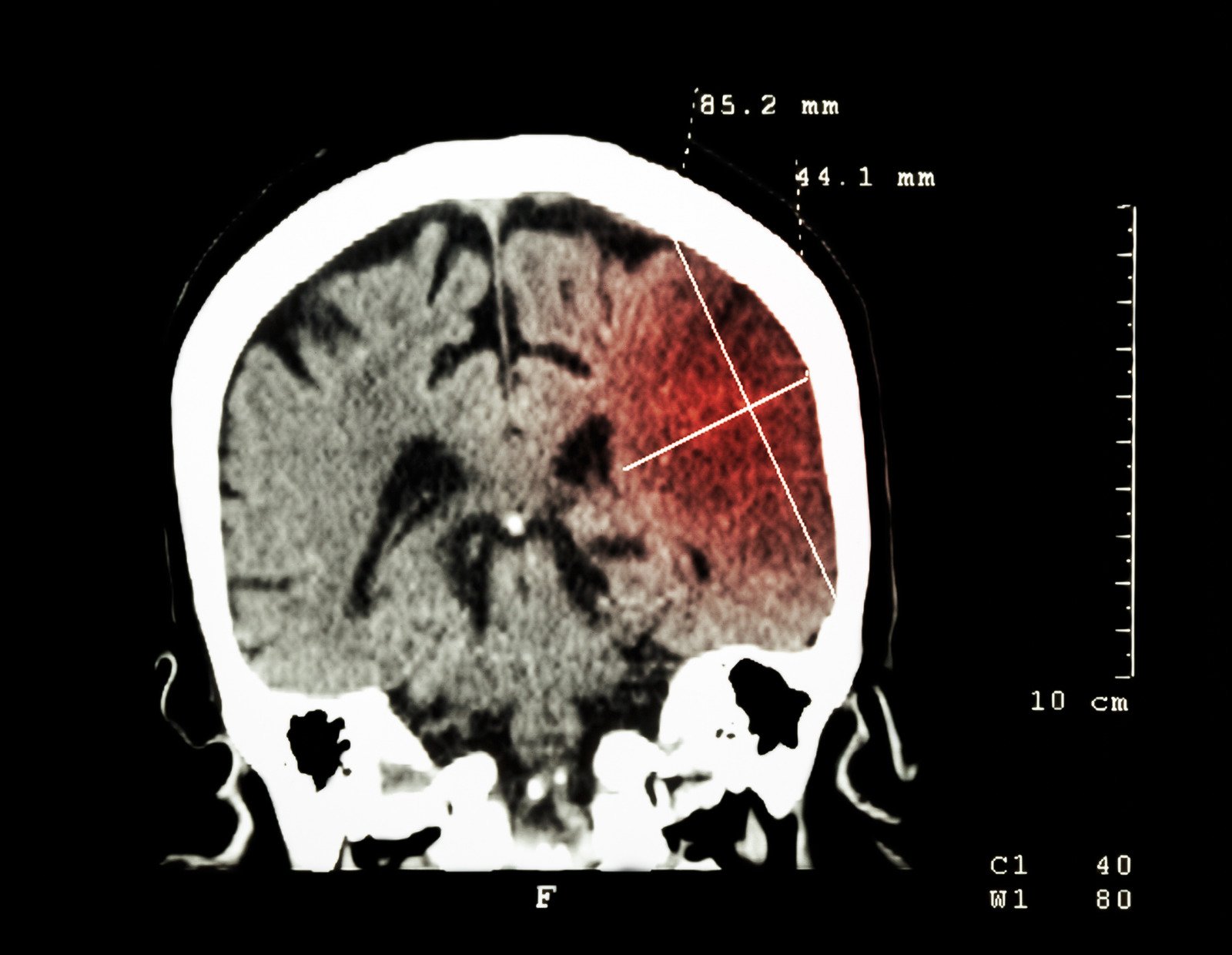 뇌경색 [Cerebral infarction]에 대한 이해