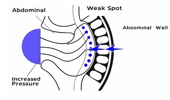 탈장 원인과 의심증상 확인하는 방법