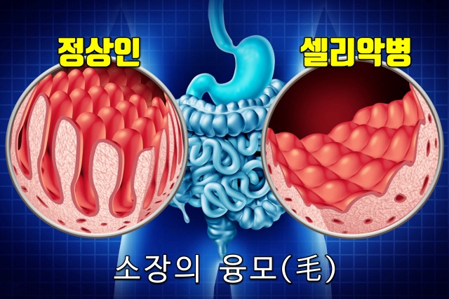 셀리악병 증상 원인, 의사 오진율, 의사 오진 대응 방안,웰빙 건강 팁줌 매일꿀정보