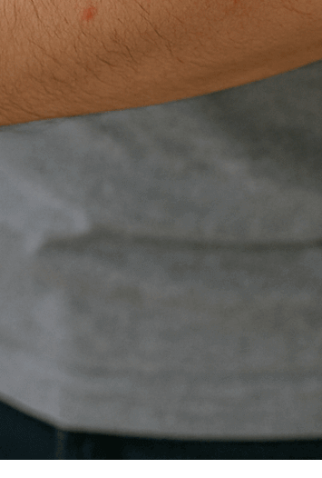 콜린성 두드러기