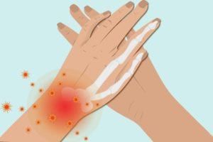 류마티스 관절염 초기증상