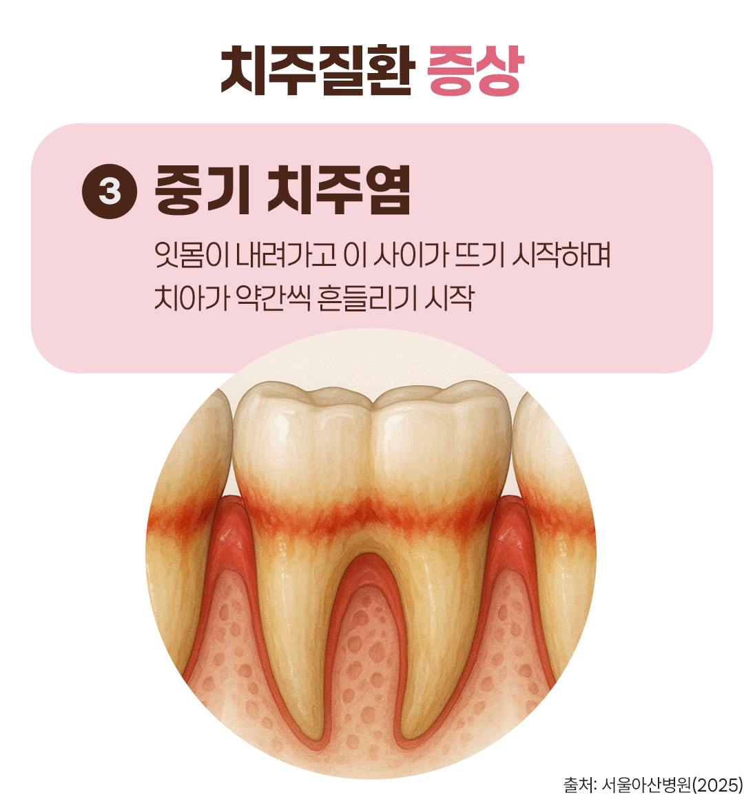 #치주질환 증상 #중기 치주염 #잇몸이 내려가고 이 사이가 뜨기 시작하며 치아가 약간씩 흔들리기 시작