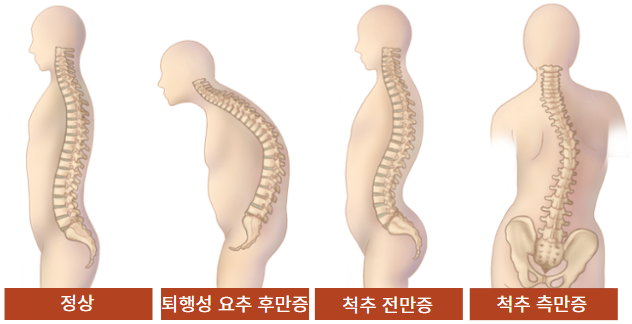 퇴행성 요추 후만증