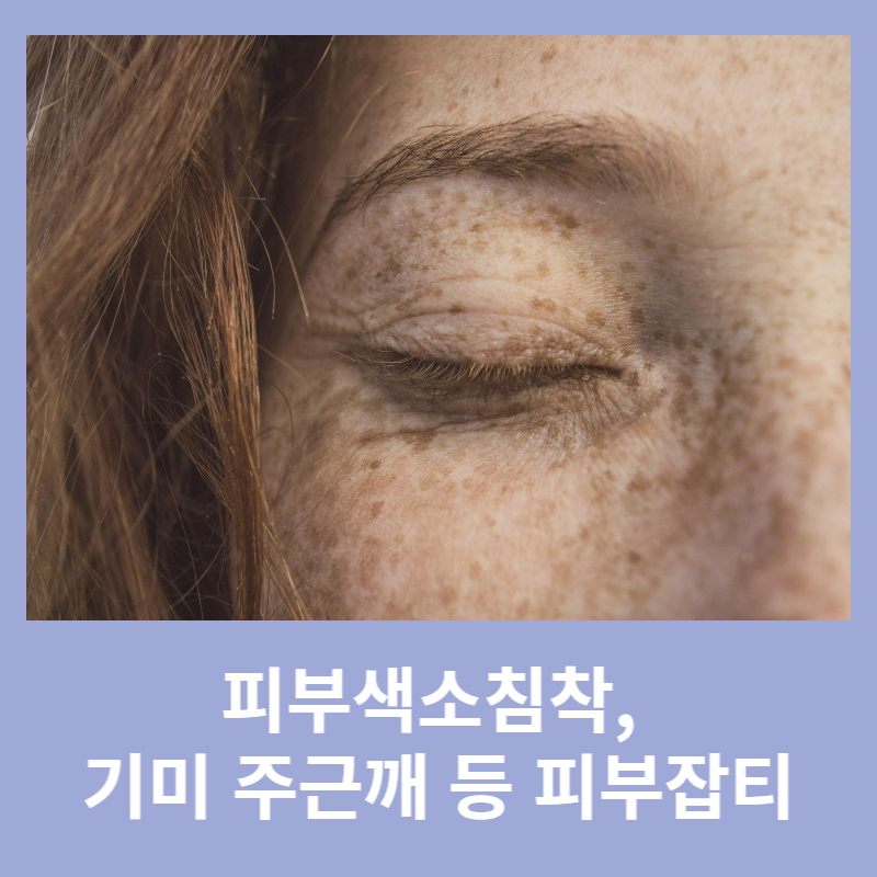피부색소침착(skin pigmentation)