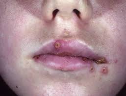 입술 포진 빨리 낫는법