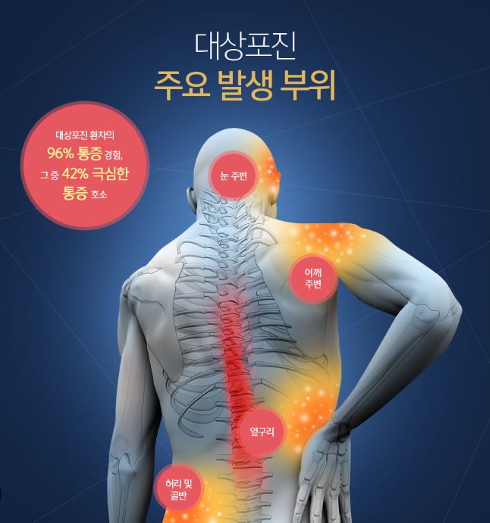 대상포진 통증부위 사진