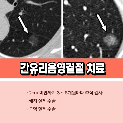 간유리음영 치료