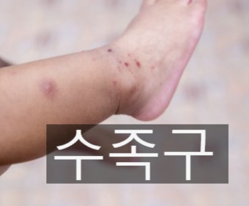 수족구 증상 - 아이 키우며 겪은 진짜 이야기