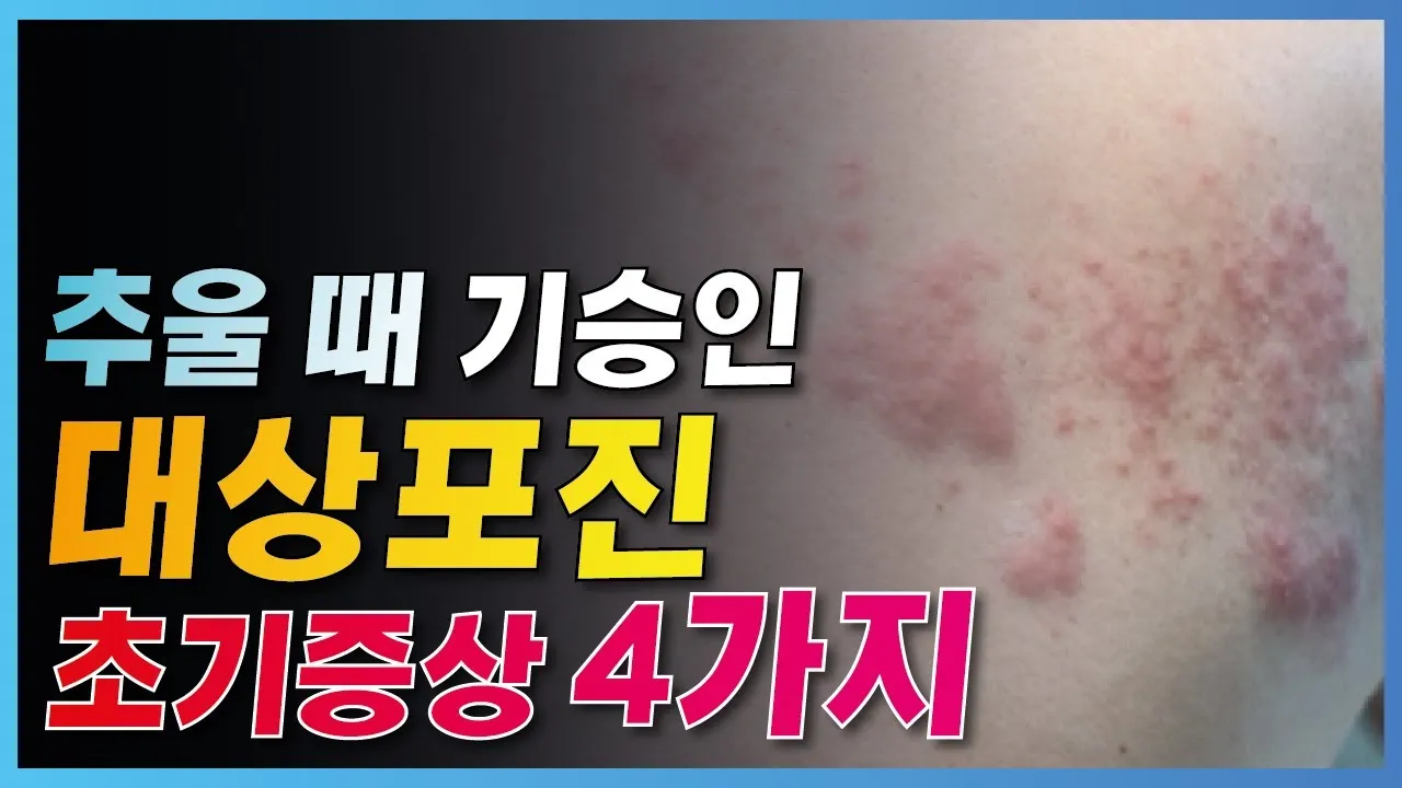 대상포진 감염 증상 부위 손 허리 허벅지_3
