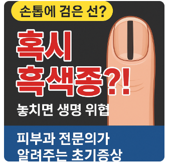 손톱에 흑색종