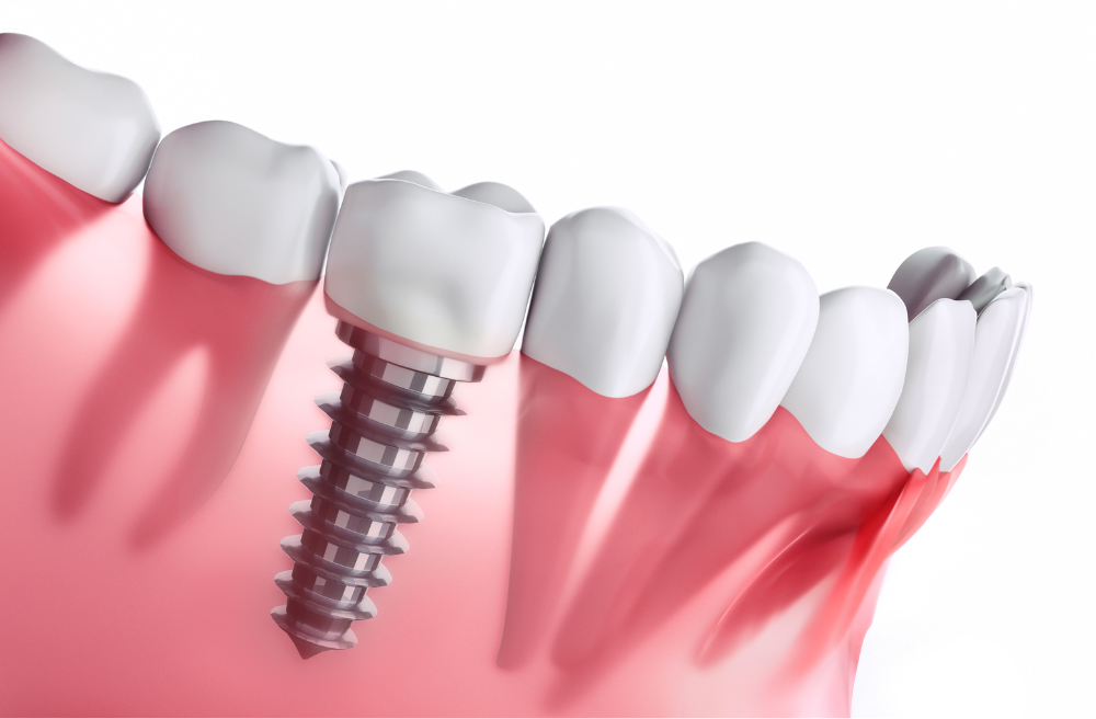 임플란트 시술 과정, 기간, 통증