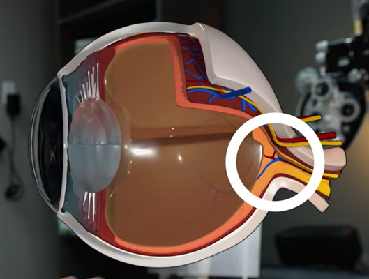 녹내장 초기증상