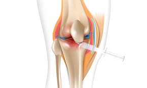 2025년 최신 무릎 연골 주사 종류 비교