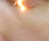 녹내장 초기 증상 &mdash; 시야를 서서히 빼앗는 침묵의 질환