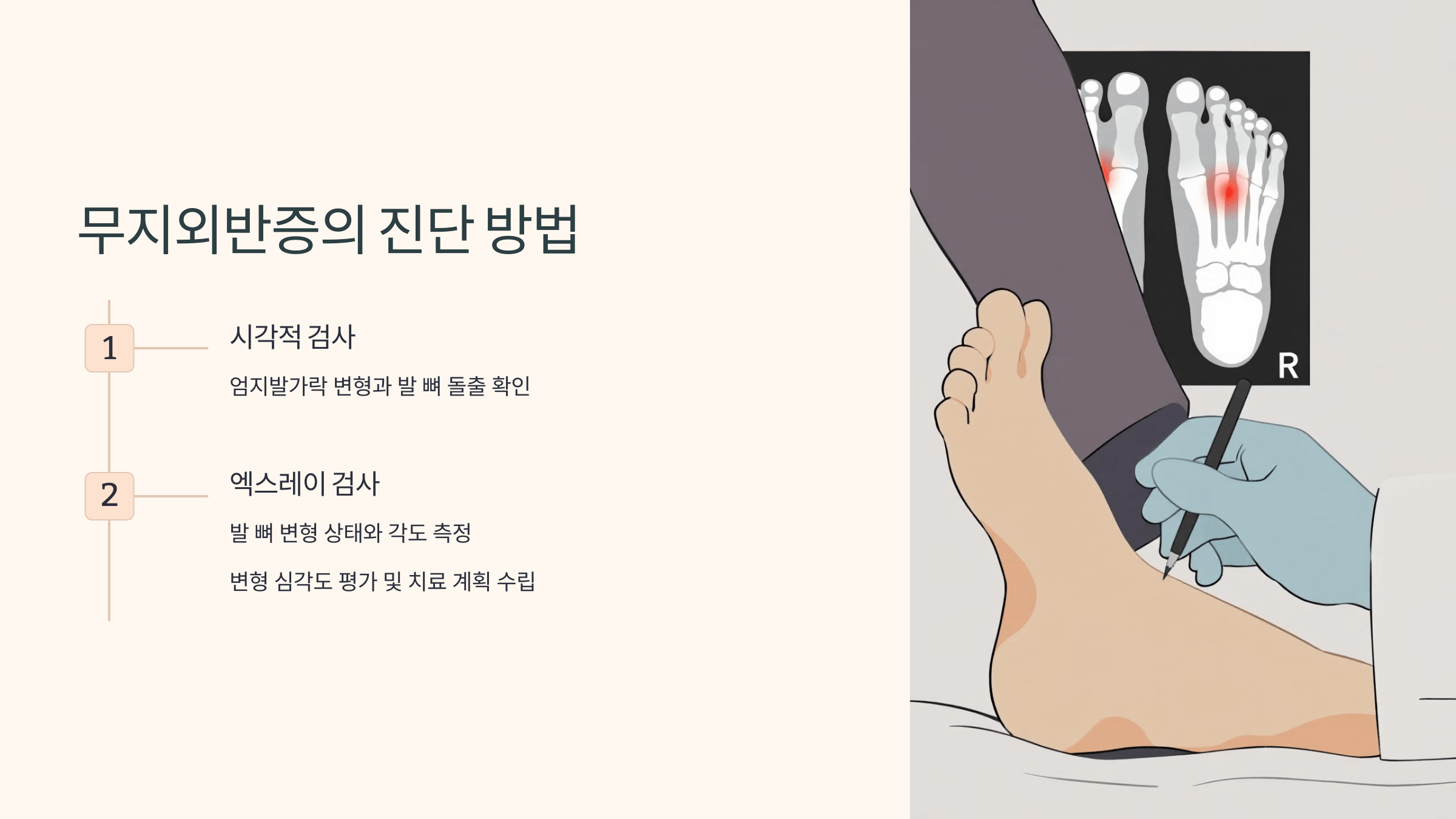 무지외반증과 관련된 사진입니다.