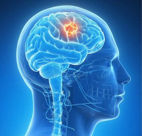 뇌종양으로 인한 인지 저하 증상 인식 관련 이미지