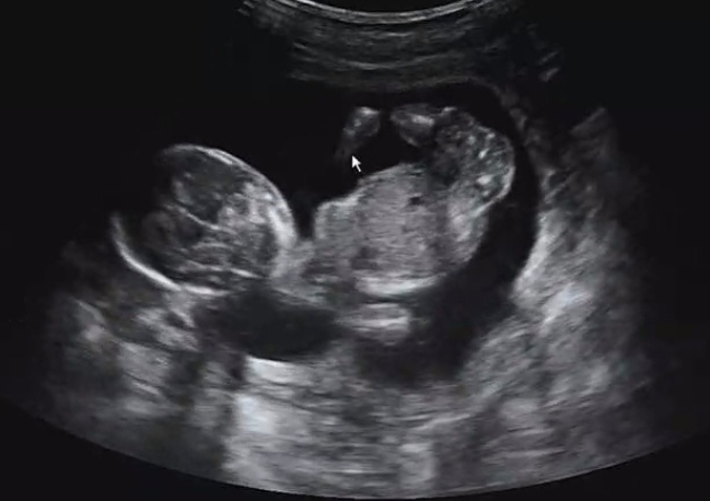 16주 태아 초음파