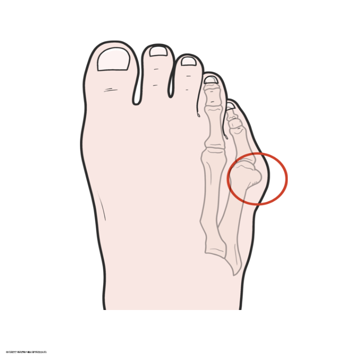 소건막류