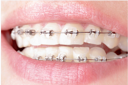 세라믹교정비용