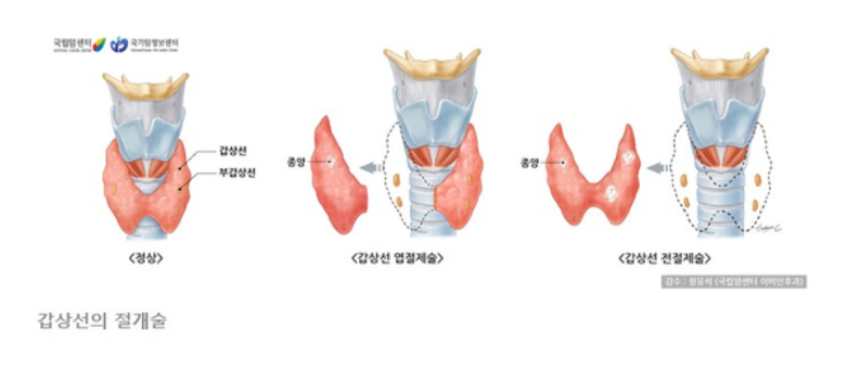 갑상선의 절개술