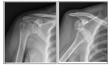어깨 탈구 엑스레이