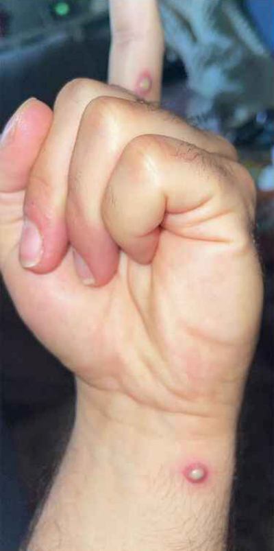 원숭이두창 증상