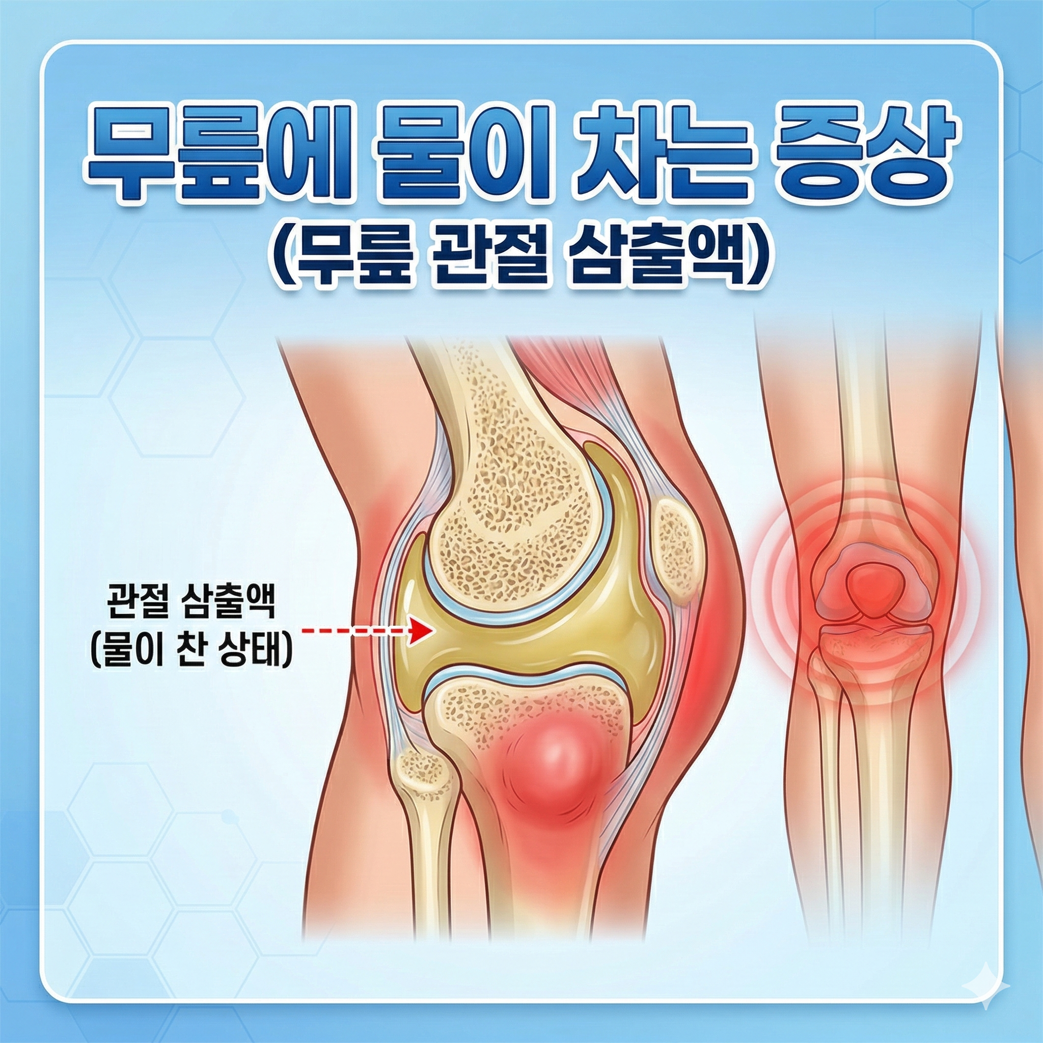 무릎에 물이 차는 증상 방치하면 안 되는 이유와 관리법
