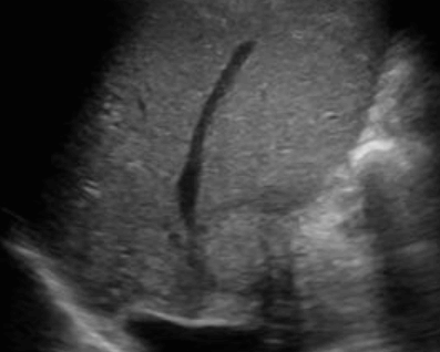 간문부 담관암(Klatskin's tumor = Hilar cholagiocarcinoma)