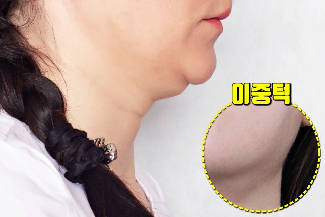 다이어트,턱살,턱밑살,이중턱,사각턱,턱선,턱밑이 붓는 이유,침샘 비대증,건강,팁줌 매일꿀정보