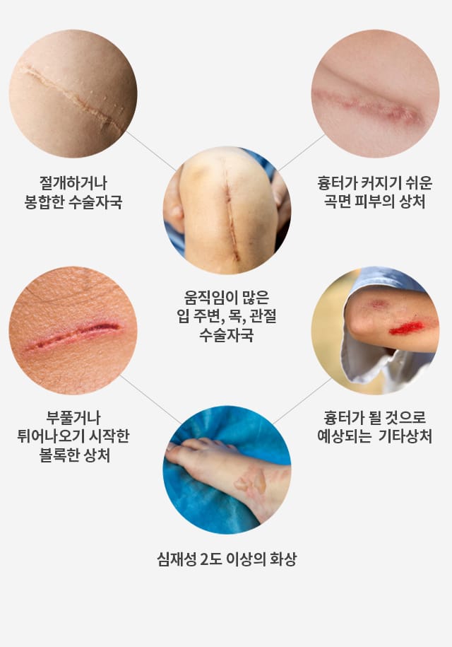 흉터 실리콘 패치 사용 시점 상처 치유 단계