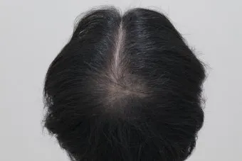 정수리가 아픈 이유와 완화하는 방법_3