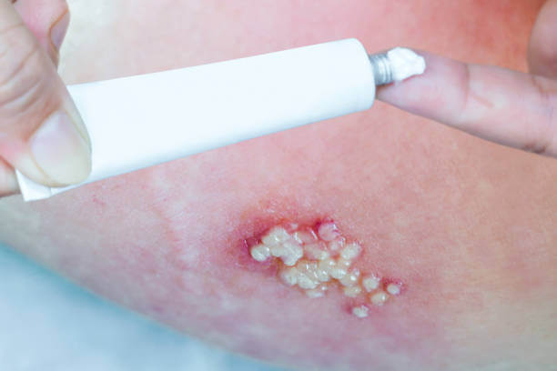 대상포진 초기증상 대표 6가지 및 통증, 치료방법에 대해 알아봤습니다. 대상포진이 걸리면 무엇보다 통증이 심해서 매우 힘들어하는데요~ 그래서 하루빨리 증상이 나타나면 병원에 가야 합니다! 증상을 확인해보세요~