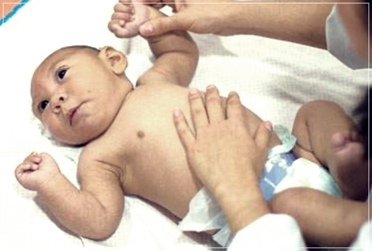 소두증 이란? 원인, 증상, 치료방법들