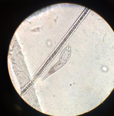 모낭염 증상&amp;#44; 원인&amp;#44; 치료 총 정리 (2025 최신)