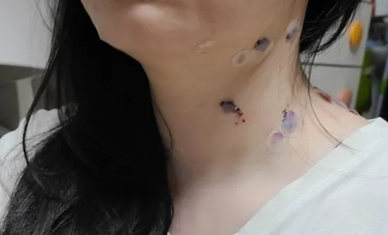 점 제거 후 관리