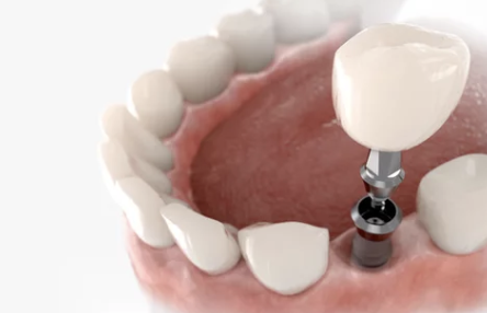 임플란트 시술 과정