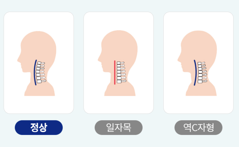 목디스크 증상 1