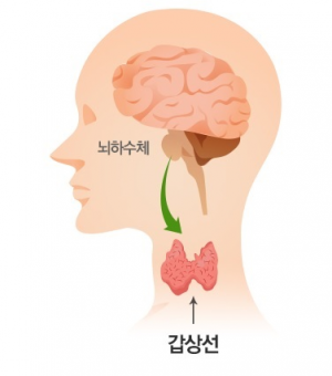 갑상선 기능 저하증 증상