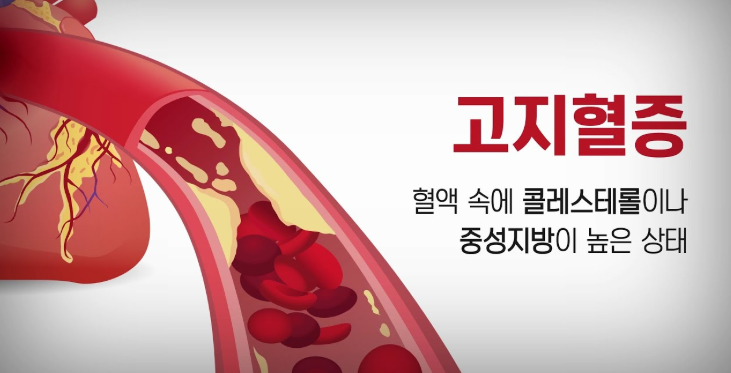 고지혈증