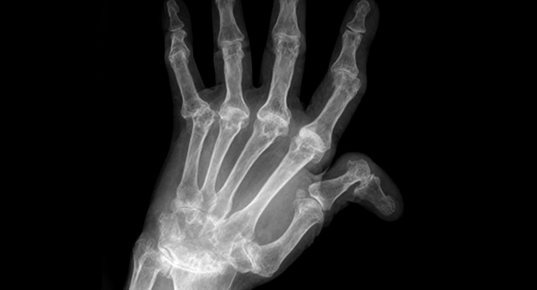 명의 류마티스 관절염