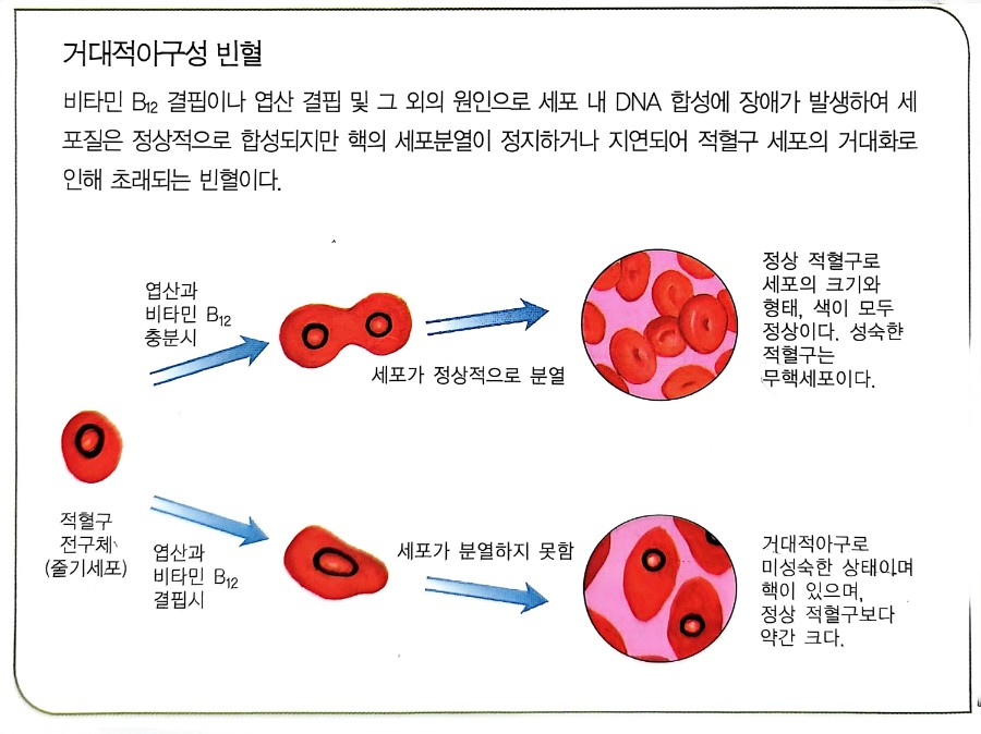 거대적아구성 빈혈