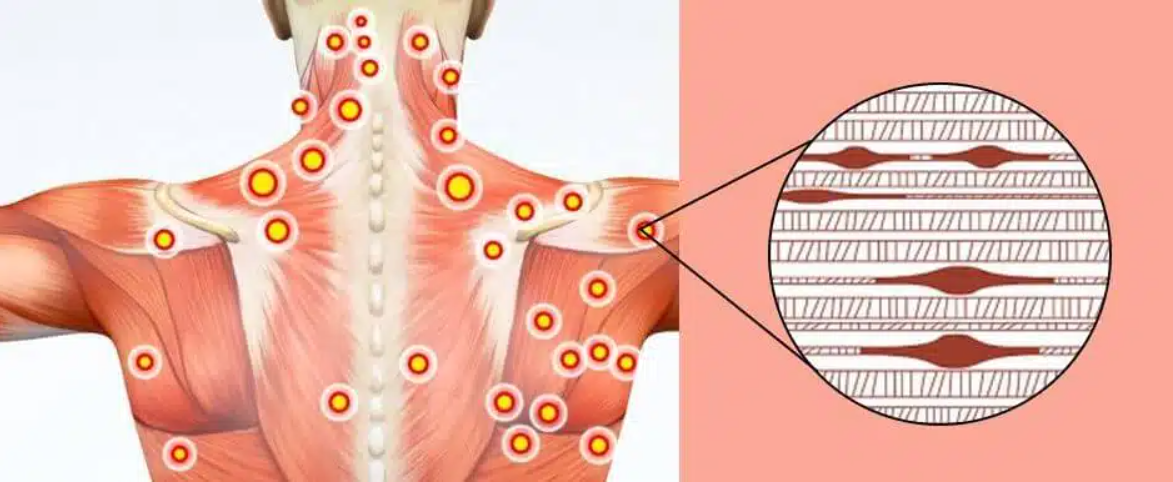 trigger point image