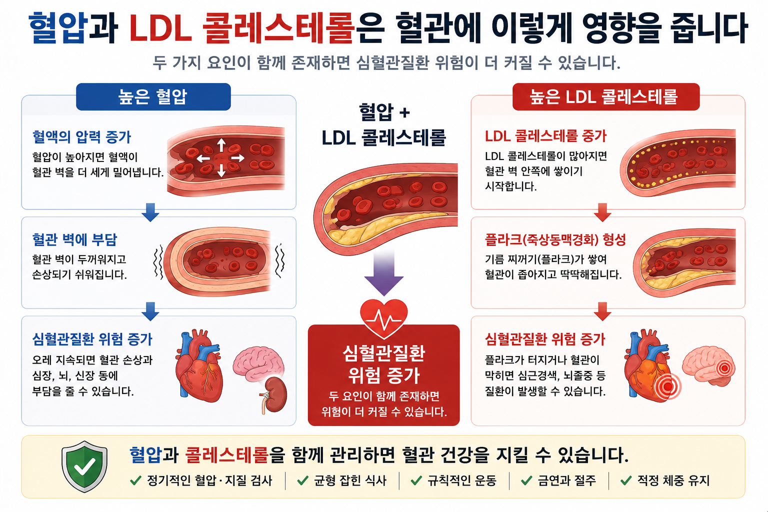 높은 혈압의 압력 부담과 LDL 관련 플라크 형성을 비교하는 그림