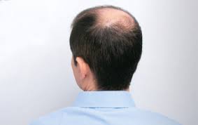 바이오틴 탈모샴푸 추천 효과 (내돈내산 솔직후기)