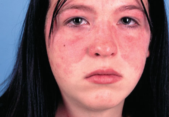 전신홍반루푸스(SLE)초기증상,원인,치료법